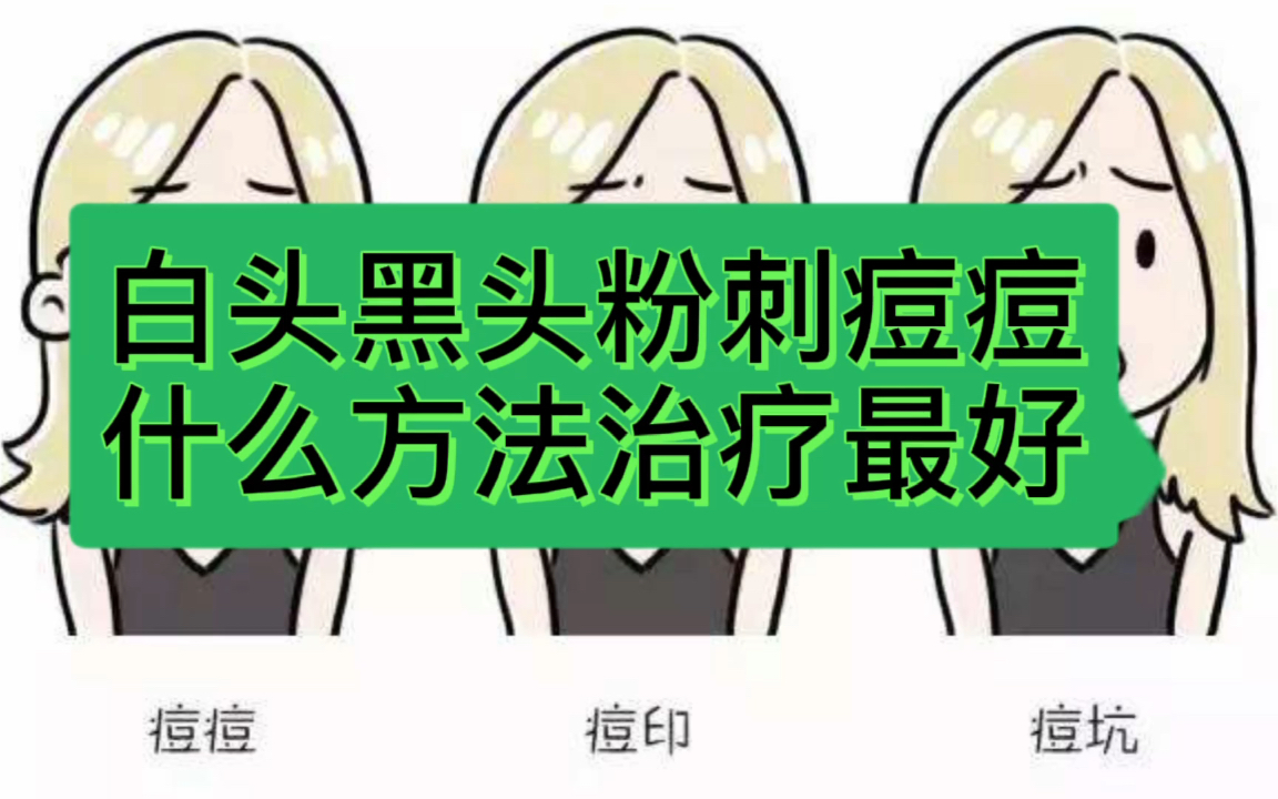 白头、黑头、闭口、粉刺、痘痘,其实都应该叫青春痘,也就是痤疮.痘痘的治疗,最好个性化为主,但是仍然有一些共性的东西值得参考哔哩哔哩bilibili