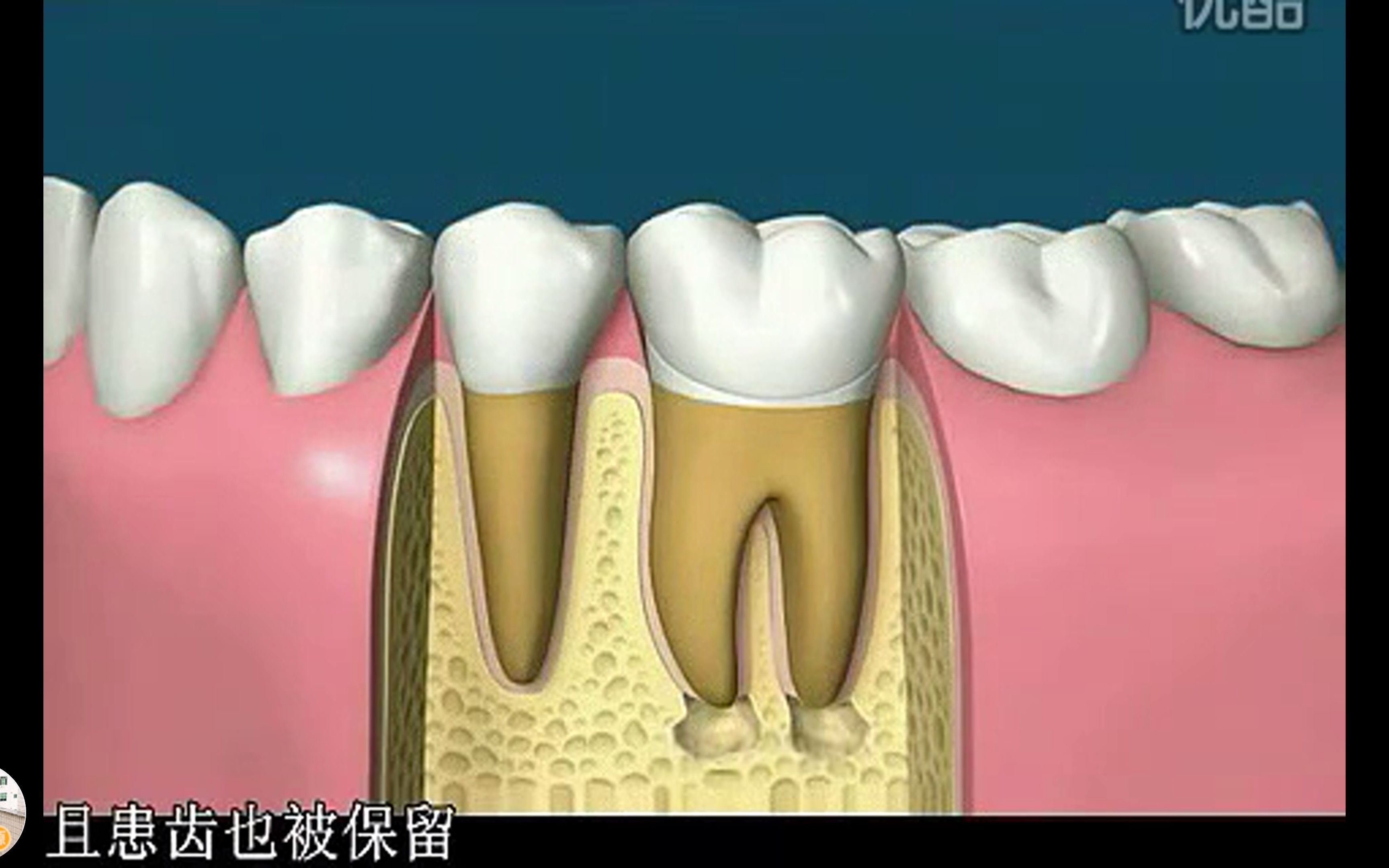 牙齿根管治疗过程动画演示,牙髓炎患者必经之路(中文字幕)哔哩哔哩bilibili