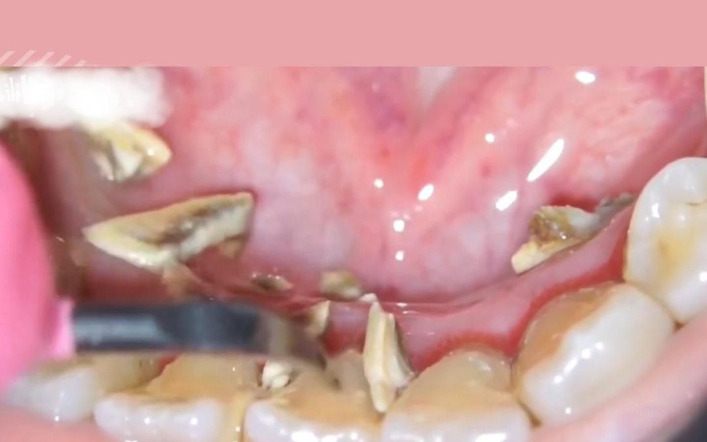 一口老牙 就靠牙结石撑着了