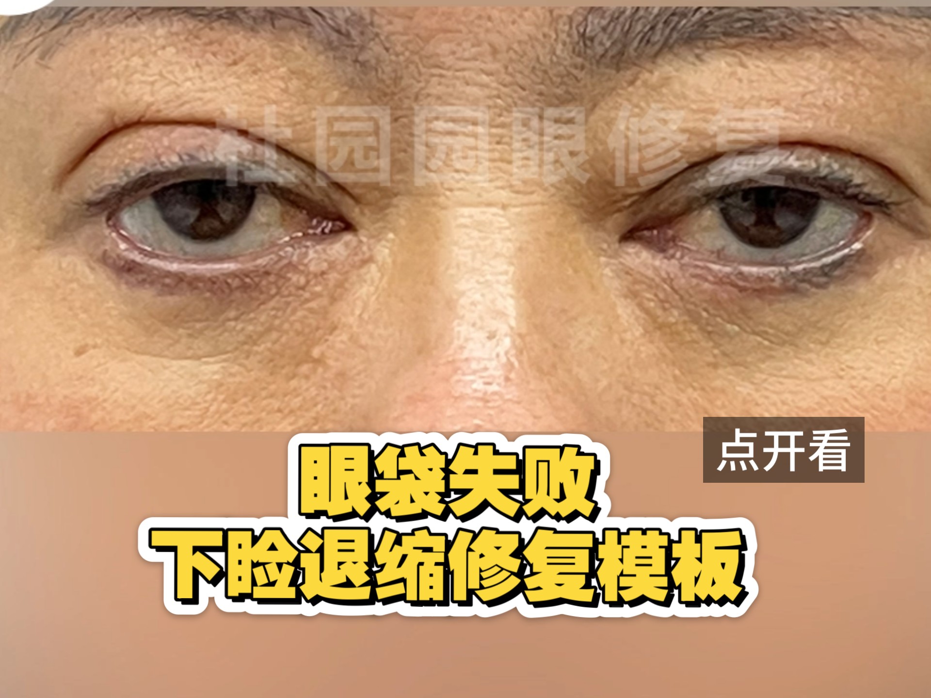 眼袋失败下睑退缩修复,点开看