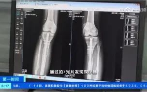 Download Video: 22岁患者国外做断骨增高手术导致双腿感染