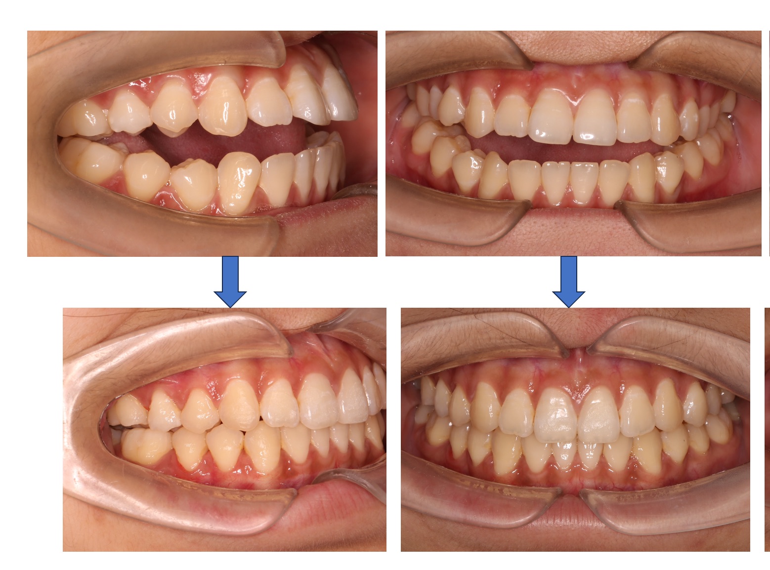 9: 隐适美 支抗钉 治疗前牙3.5 mm开合