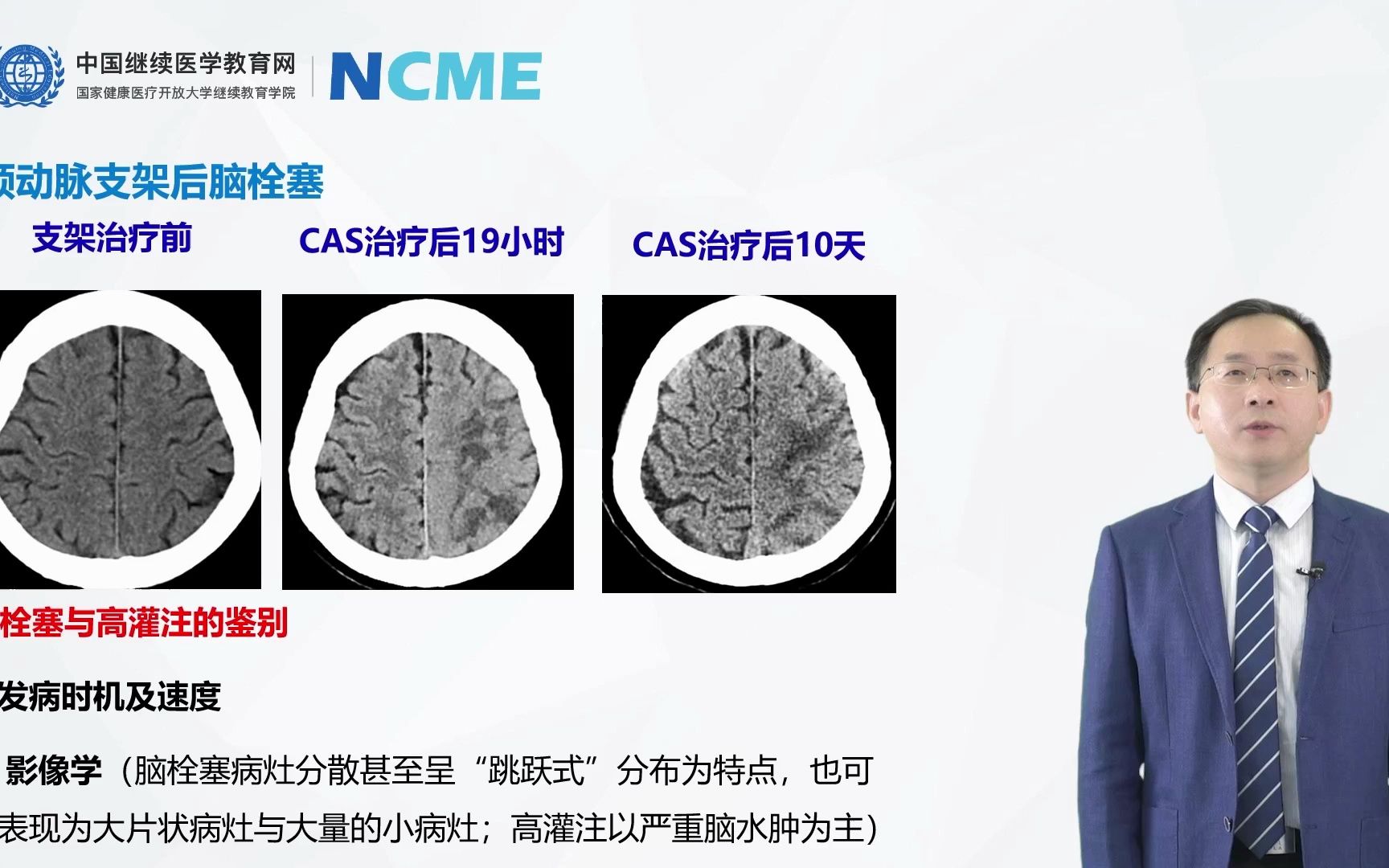 国家级培训继续教育缺血——颈动脉狭窄栓塞保护装置的选择和进展哔哩哔哩bilibili