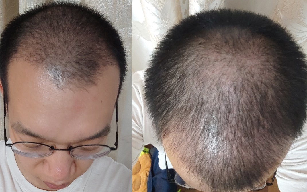 植发第三期,术后30天(一个月)