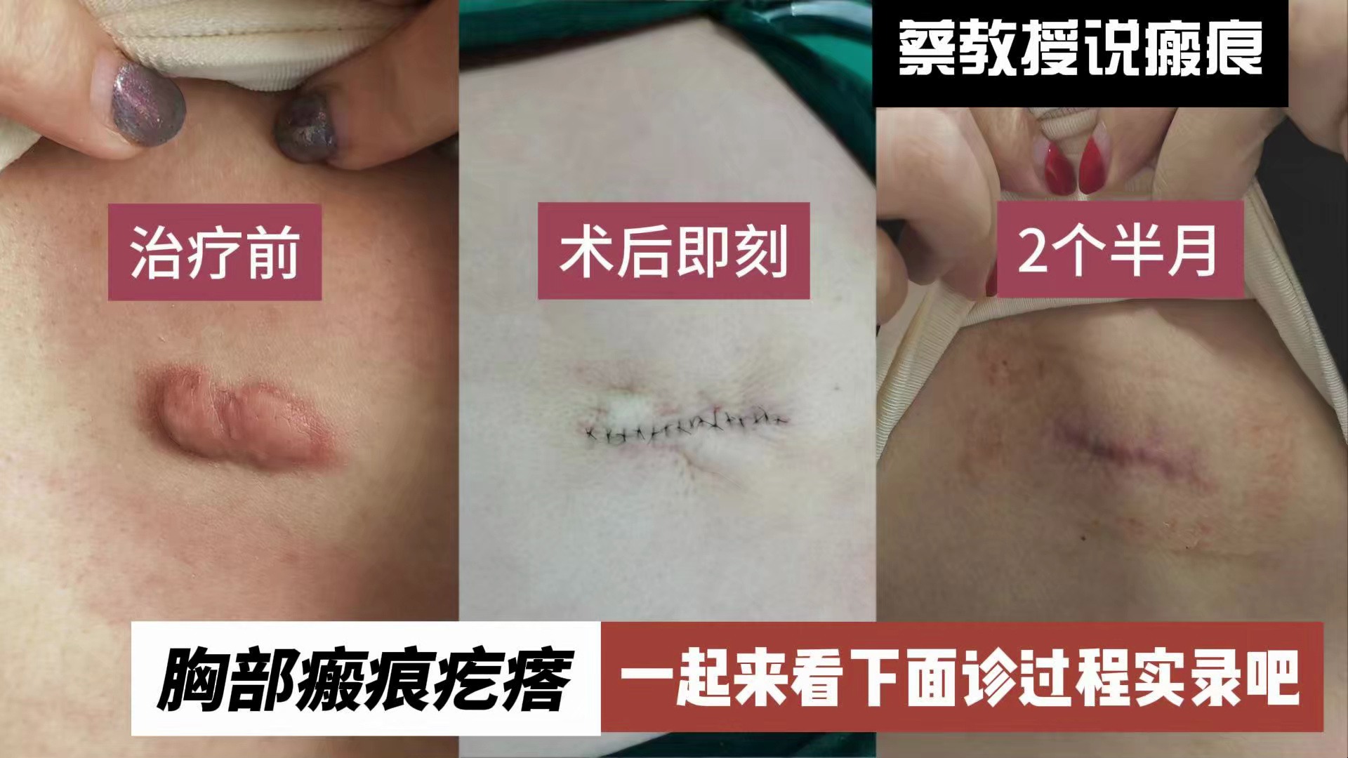蔡景龙教授关于胸部瘢痕疙瘩的面诊实录