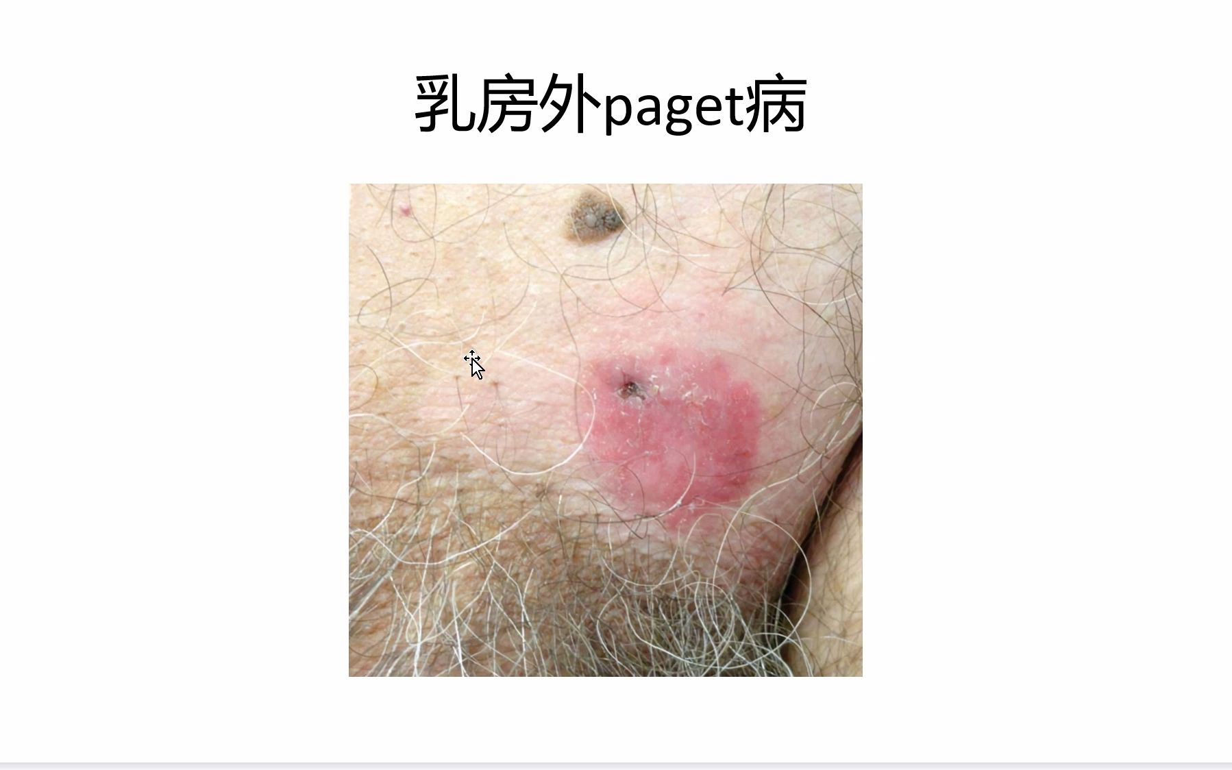 皮肤病及病理学习乳房外paget病哔哩哔哩bilibili