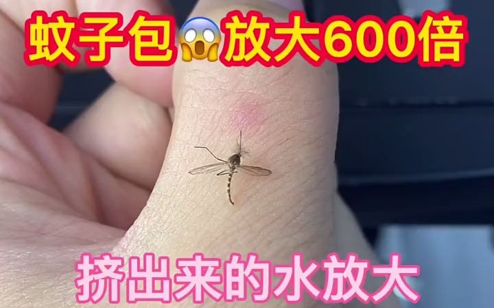 [图]蚊子包放大600倍