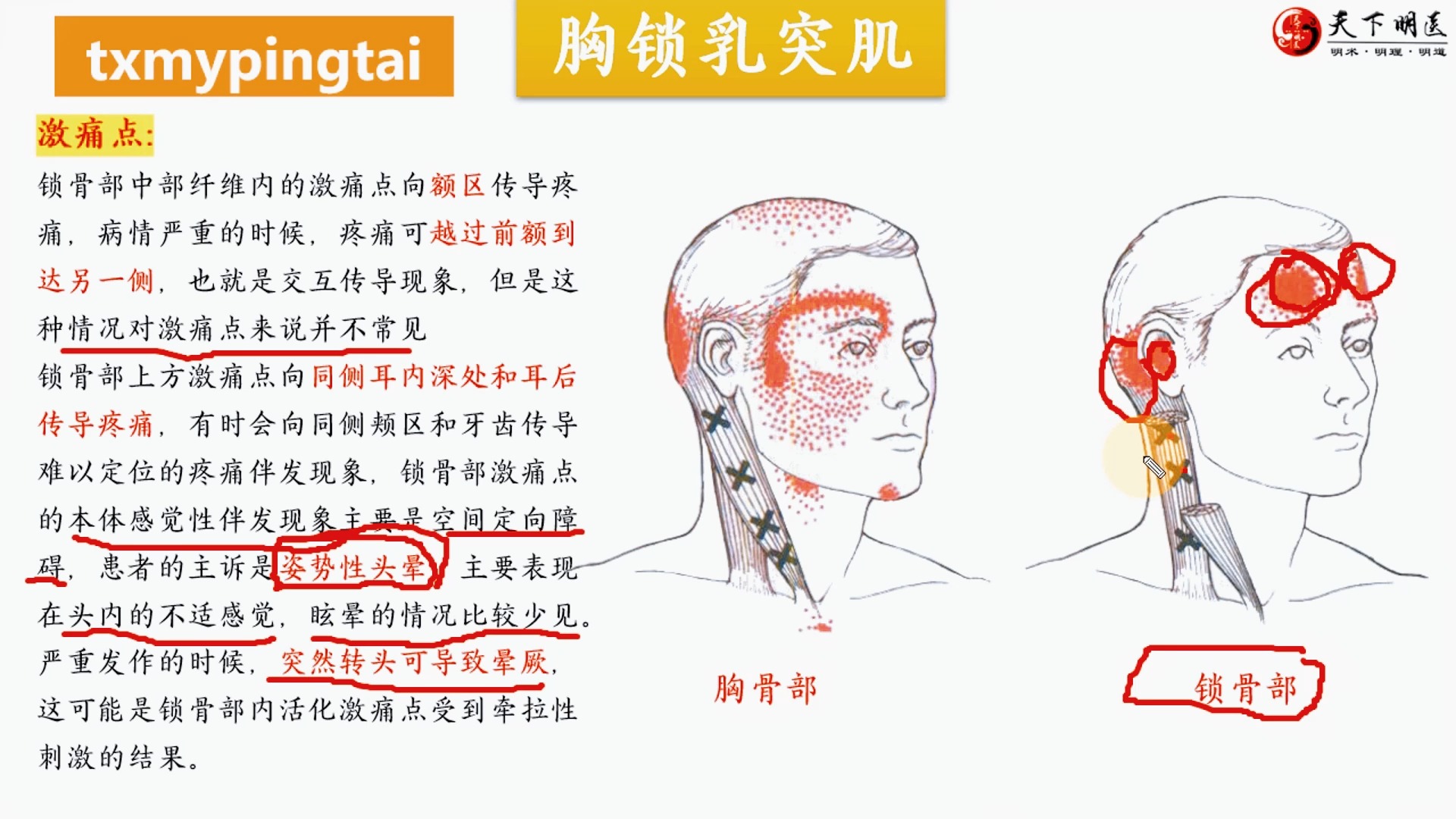 胸锁乳突肌拉伤图片