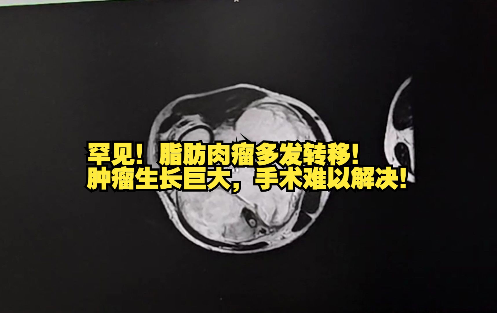 脂肪肉瘤多發轉移,腰椎和骶骨的腫瘤生長非常誇張,十分十分罕見的病例