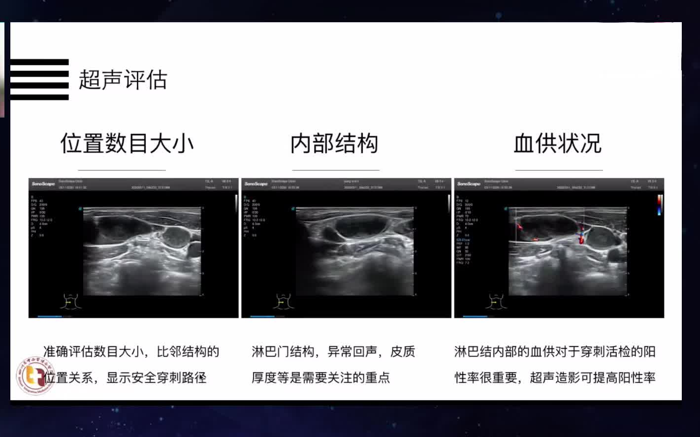 [图]超声引导下浅表淋巴结穿刺活检 搬运自用