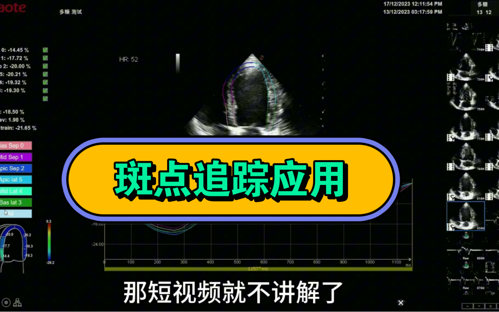 百胜医疗的斑点追踪超声心动图技术应用.哔哩哔哩bilibili