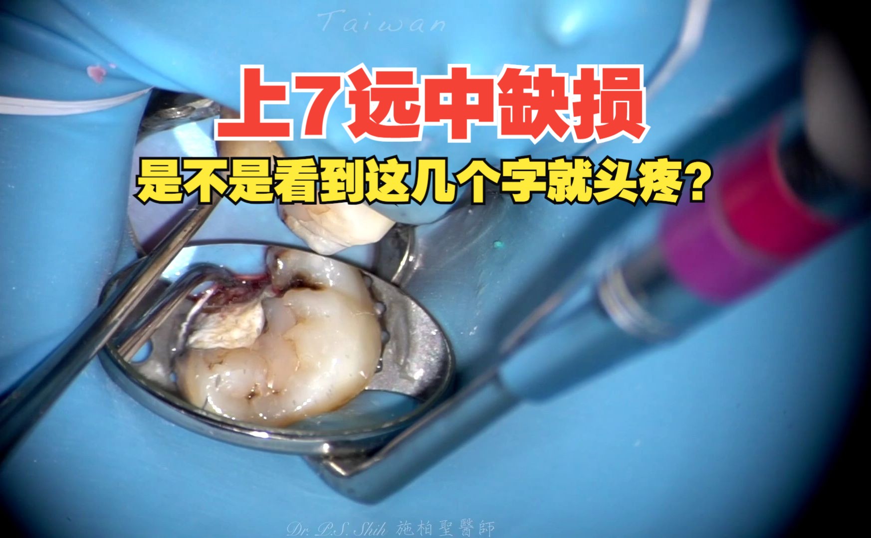 上颌第二磨牙远中缺损的解决流程:7 distal破洞啦! 如何防水隔湿?如何建壁?哔哩哔哩bilibili