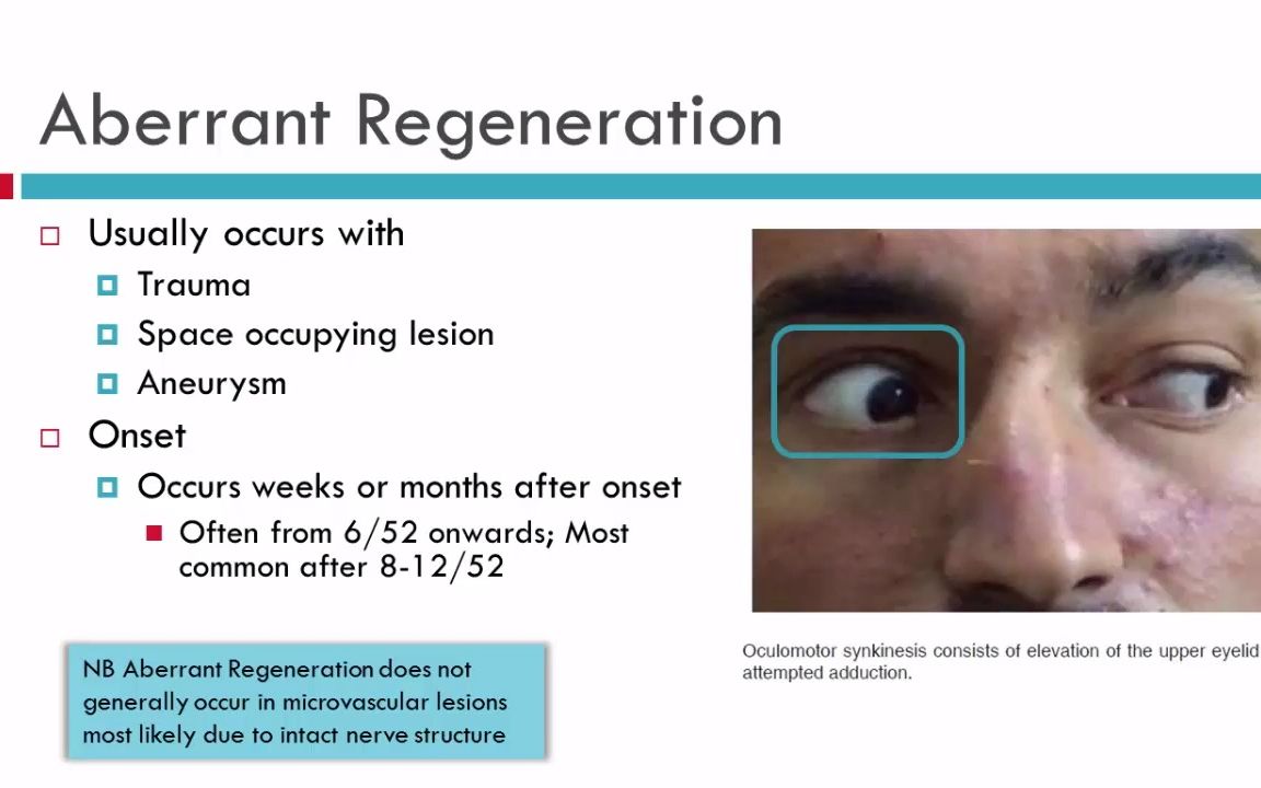 IIIrd CN Palsy Aberrant Regeneration哔哩哔哩bilibili