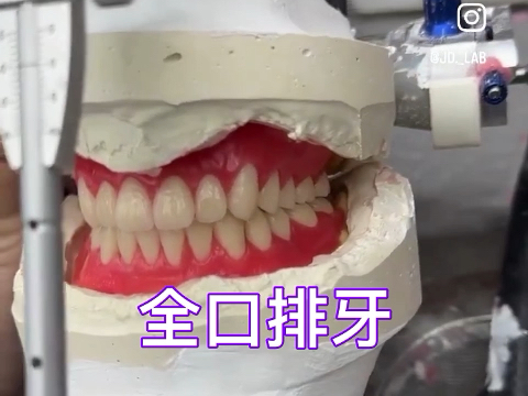 全口胶托排牙
