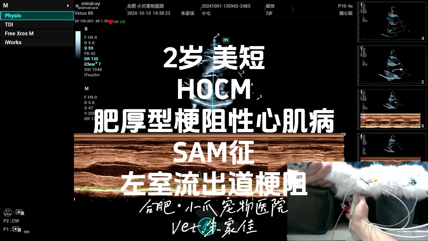 2岁美短猫,雄性(已去势),HOCM 10.1日初诊至10.13日复诊 心肌厚度变化虽然不大,但SAM征与LVOTO的情况已大幅好转,期待下次复查的结果.哔...