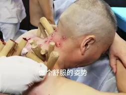 Descargar video: 肩颈疼痛，痛点出痰，又黏又黑，出的量还可以，相对好点了