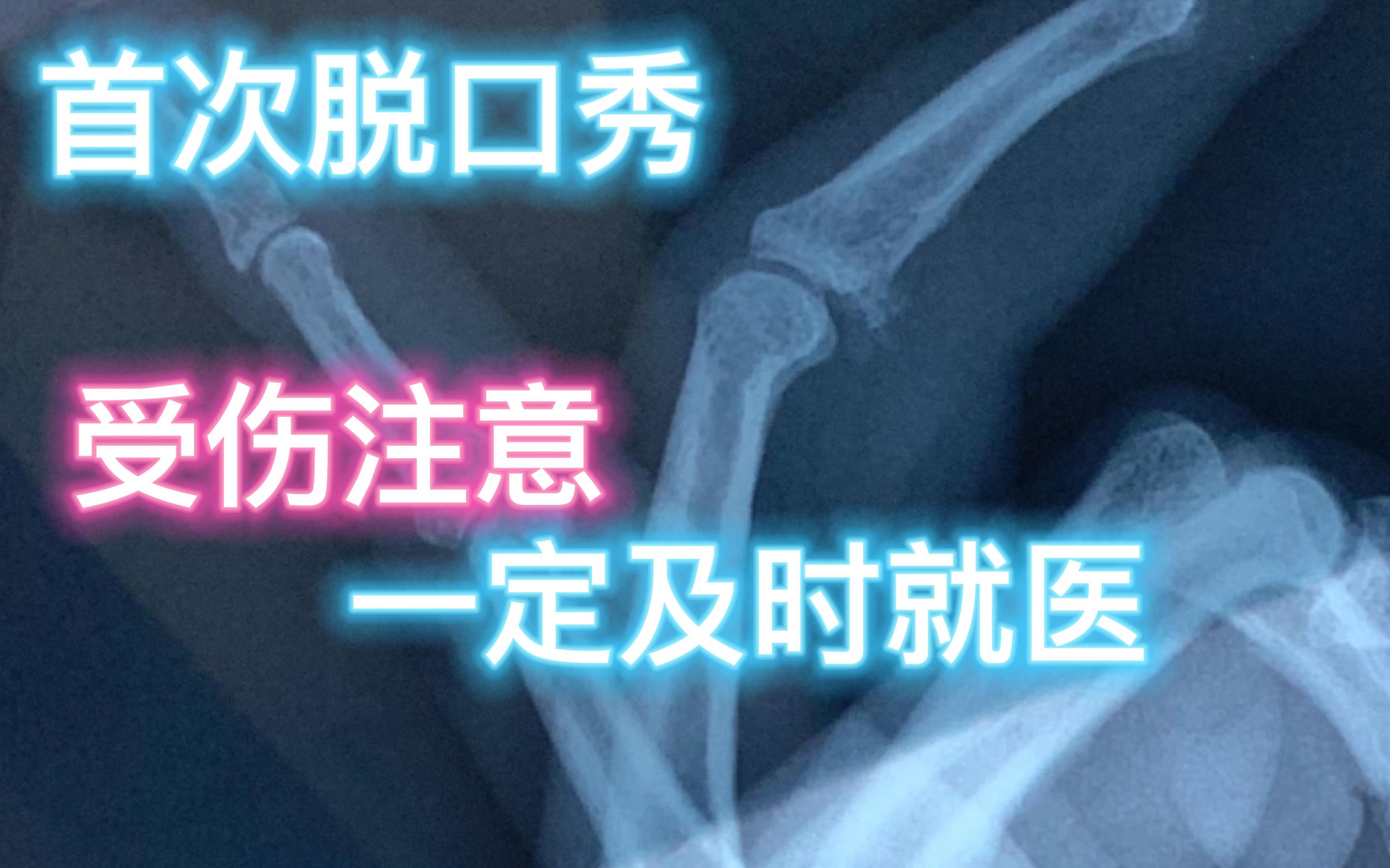 揭秘:指点南开胡金牛教授的那根手指,是这么来的……受伤快去看医生,别像我……戴上刑具,天天疼的嗷嗷叫哔哩哔哩bilibili