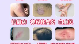 Download Video: 常见皮肤病