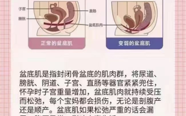 不要在漏尿時9015才想起做盆底肌修復6015更不要在腰疼背疼時