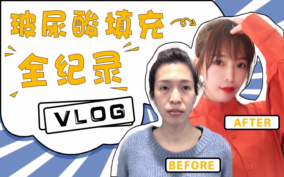 {整形vlog}微整全记录,玻尿酸全脸填充,只是玻尿酸就可以从阿姨变成少女?!哔哩哔哩bilibili