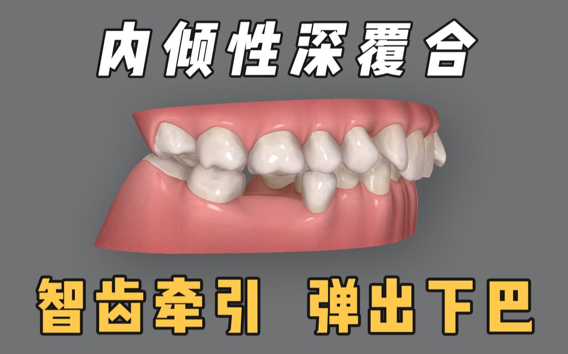 隐适美居然能做大量推磨牙前移!种牙的钱说省就省!还能弹出下巴!哔哩哔哩bilibili