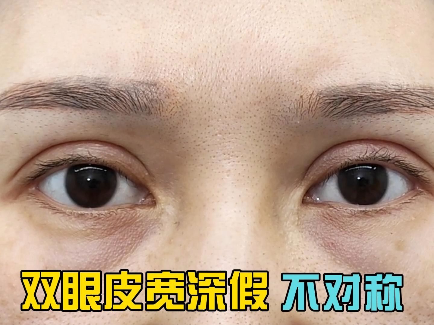 双眼皮宽 深 假 不对称 线条不流畅的女士 一年后双眼皮变窄 线条流畅