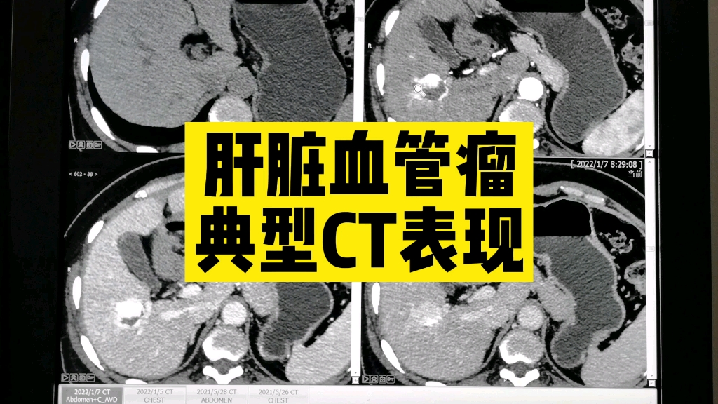 肝脏血管瘤症状是什么(了解肝脏血管瘤可能出现的症状)