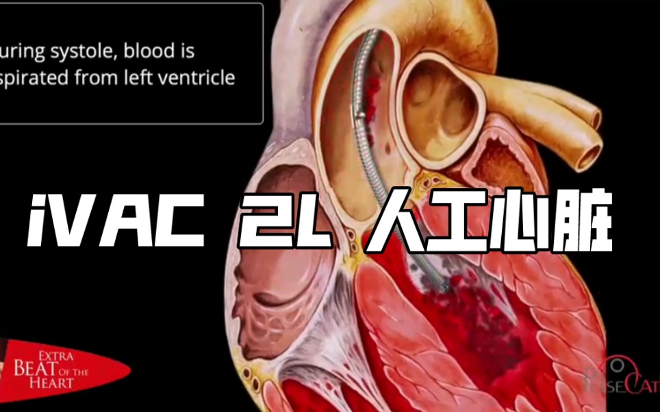 iVAC 2L : 新型脉动型人工心脏(左心室辅助装置)连接IABP机器,产生脉动血流,辅助心室工作,最高流量2L,用于辅助高危心脏手术患者#LVAD哔哩...