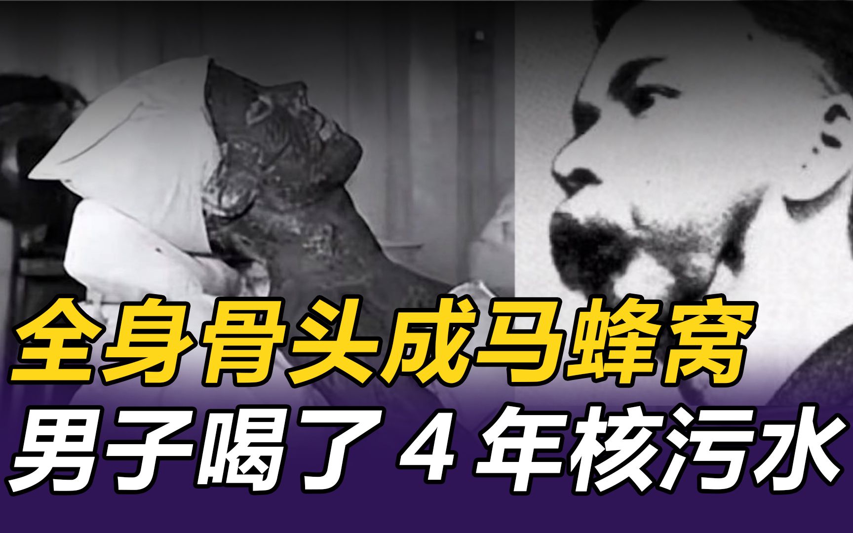 日本核废水排海后果有多严重?看这个喝了四年核废水的男人就知道,全身骨头烂成蜂窝状哔哩哔哩bilibili