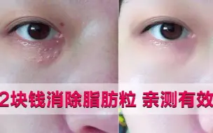 Download Video: 眼角脂肪粒不能挤，只需2招有效去除不花钱，就是这么简单