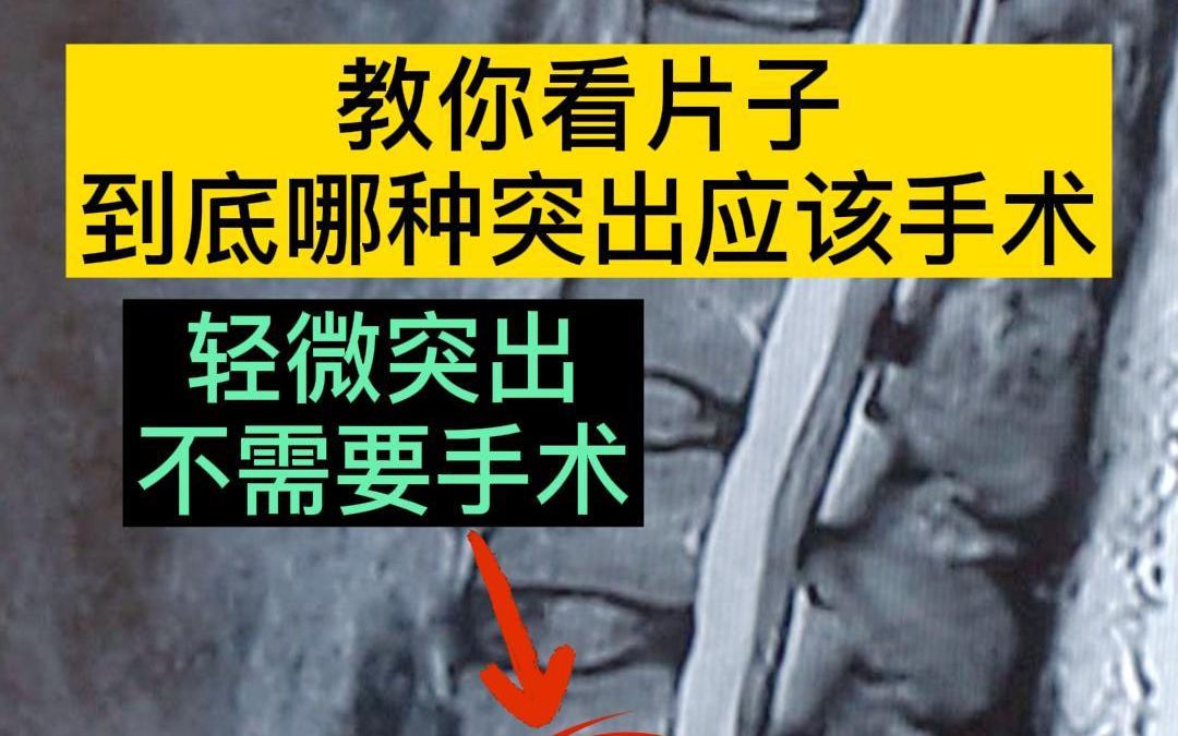 [图]腰椎间盘突出，一步一步教你看片子！