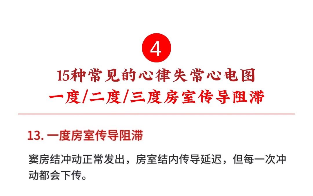 15种常见的心律失常心电图4:一度/二度/ 三度房室传导阻滞哔哩哔哩bilibili