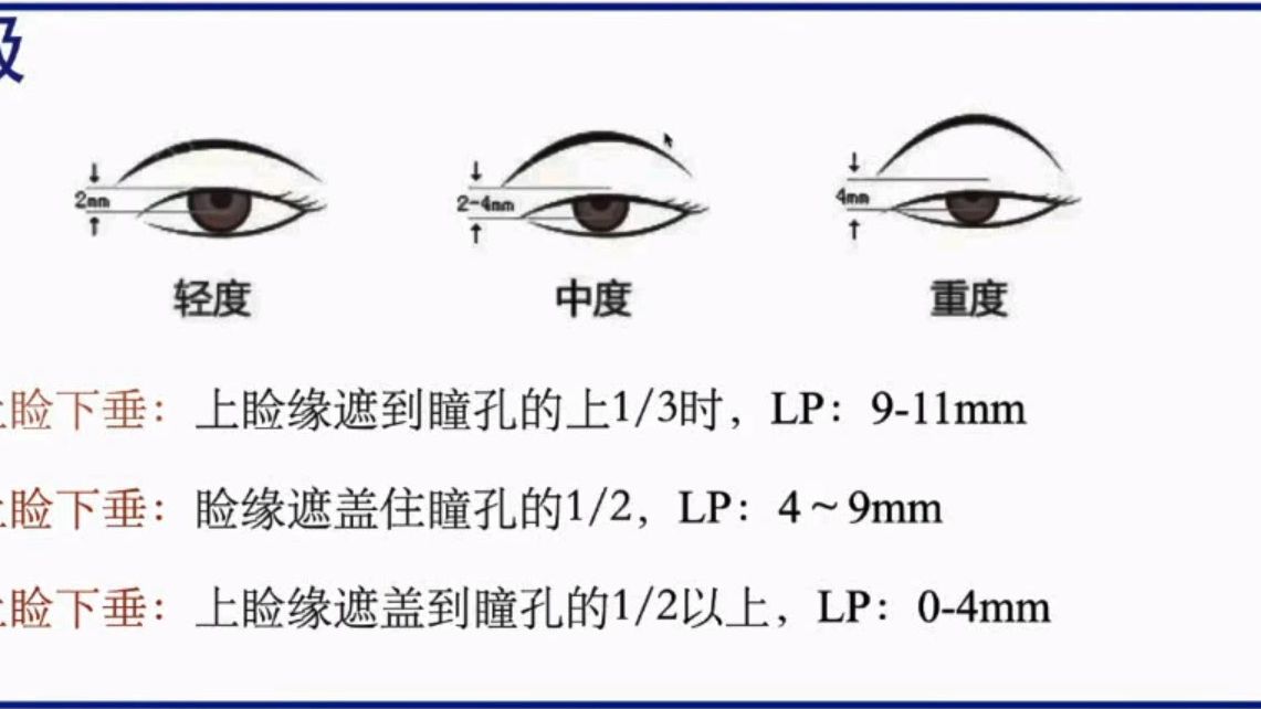 上睑下垂病例4例 张艺丹上海儿童医院哔哩哔哩bilibili