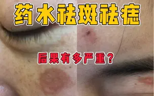 Tải video: 【皮肤医生刘静穆】药水祛斑祛痣的后果有多严重？该怎样恢复？