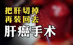 Download Video: 阿姨肝癌，医生：把肝切掉，处理干净了再给你装回去。