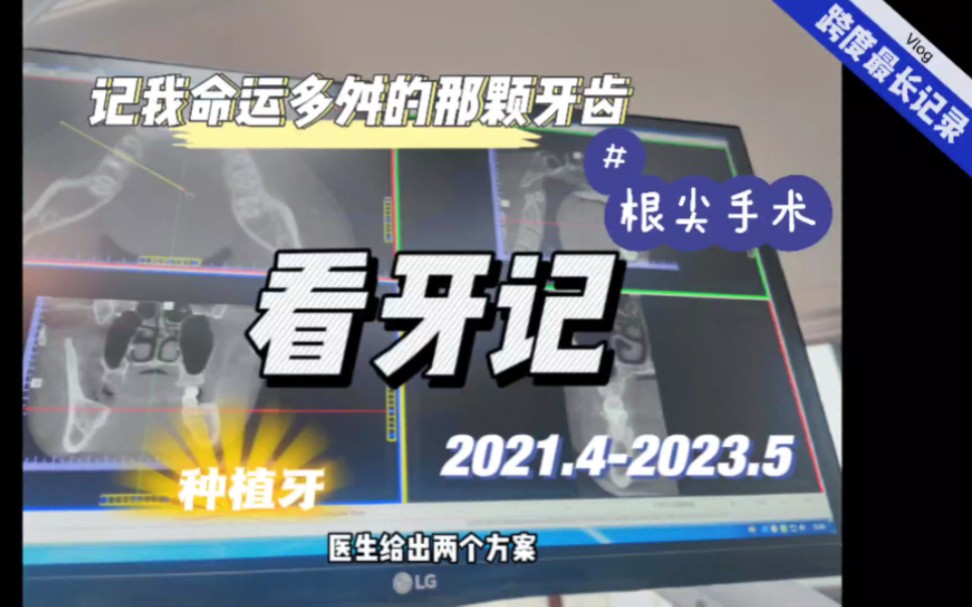 历时两年多的看牙记,期间经历了根管治疗、根尖手术、种植牙等,绍兴地铁杭州换乘实现跨市看牙,两年多的记录,终于完结,一切尽在视频中哔哩哔哩...