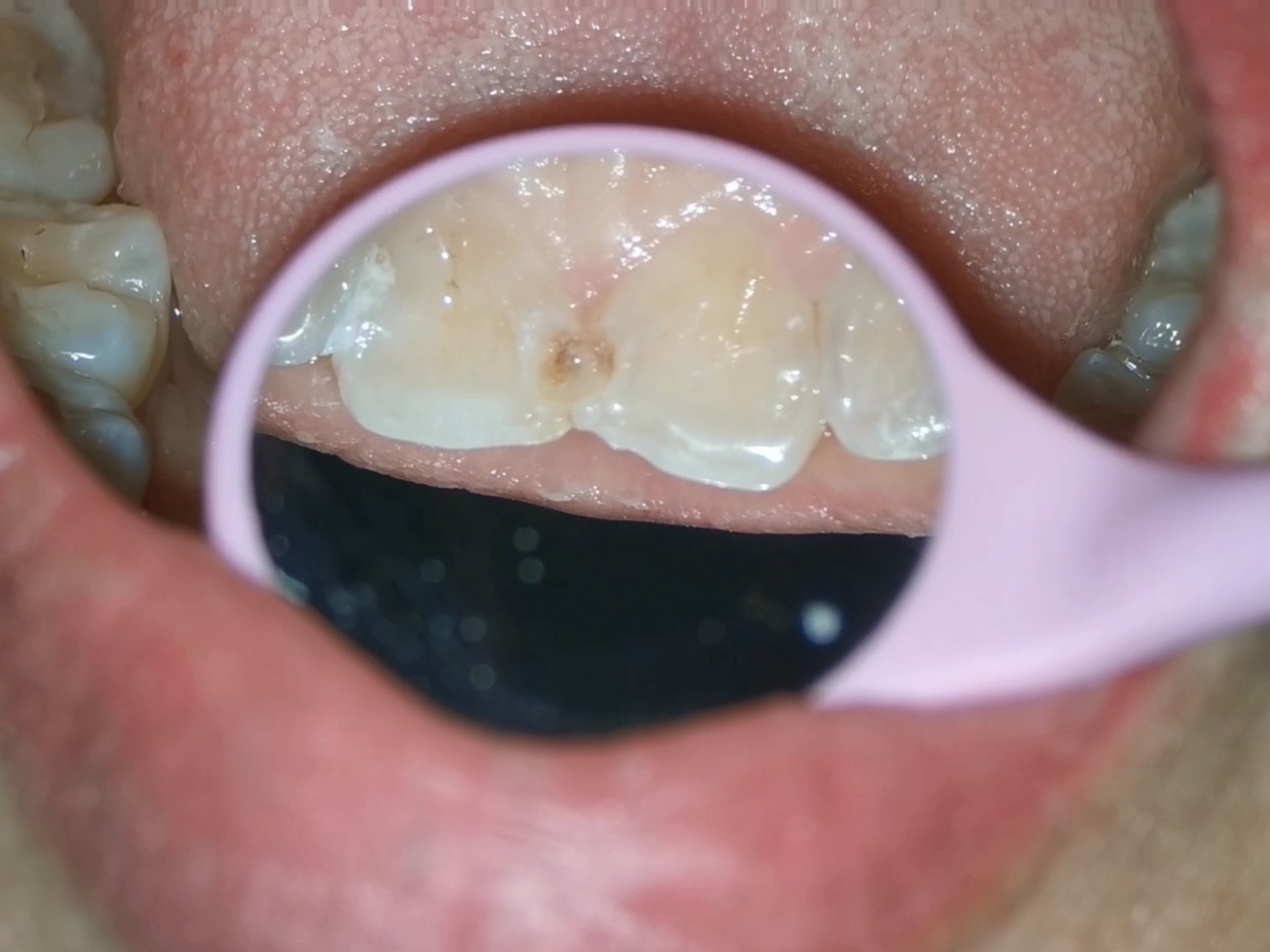 门牙中间黑了,原来是蛀牙,清理干净后树脂补起来!