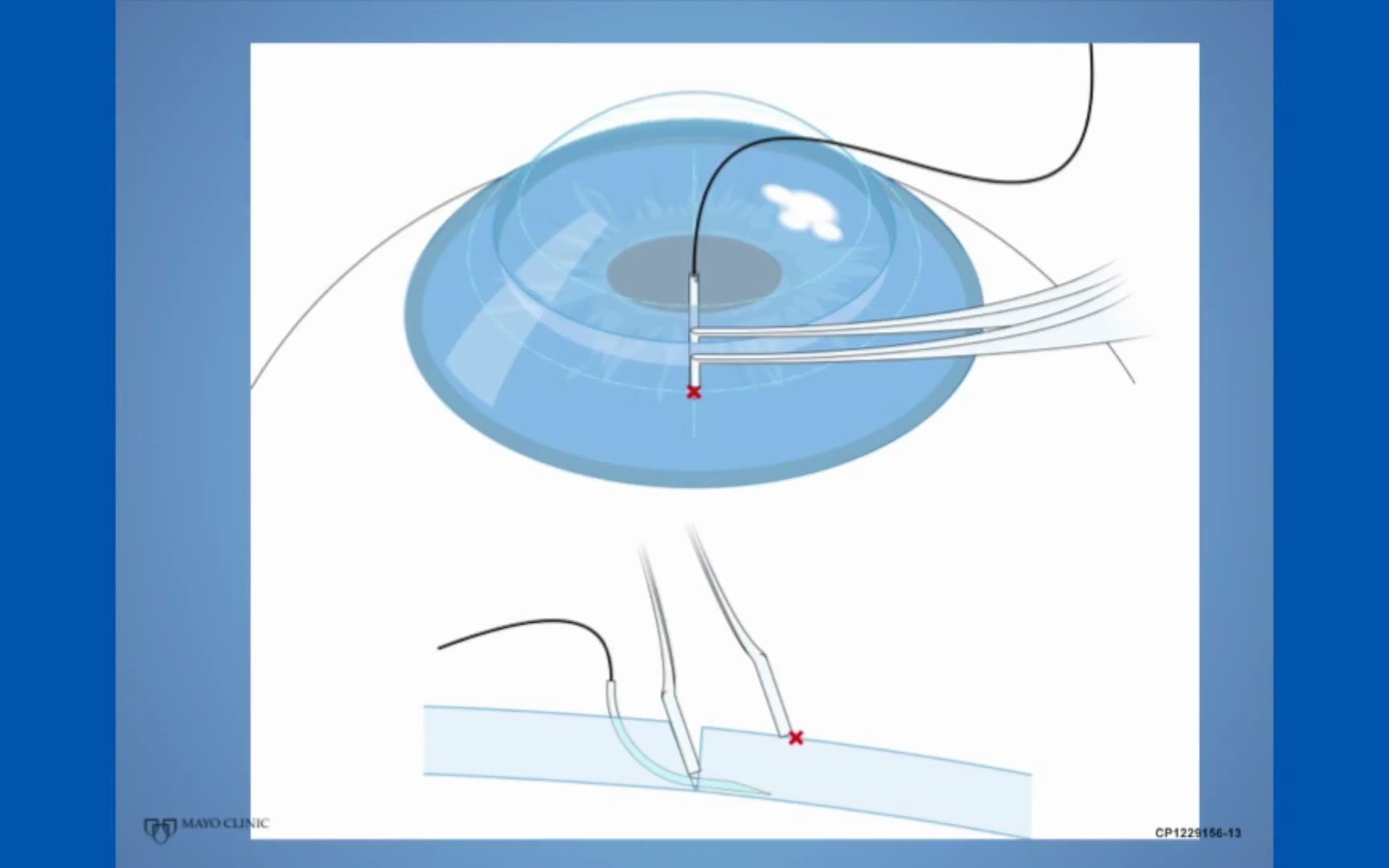 角膜缝合保姆级教学 part 4