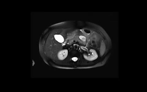 053 (十二指肠硬纤维瘤)Duodenal desmoid tumor哔哩哔哩bilibili