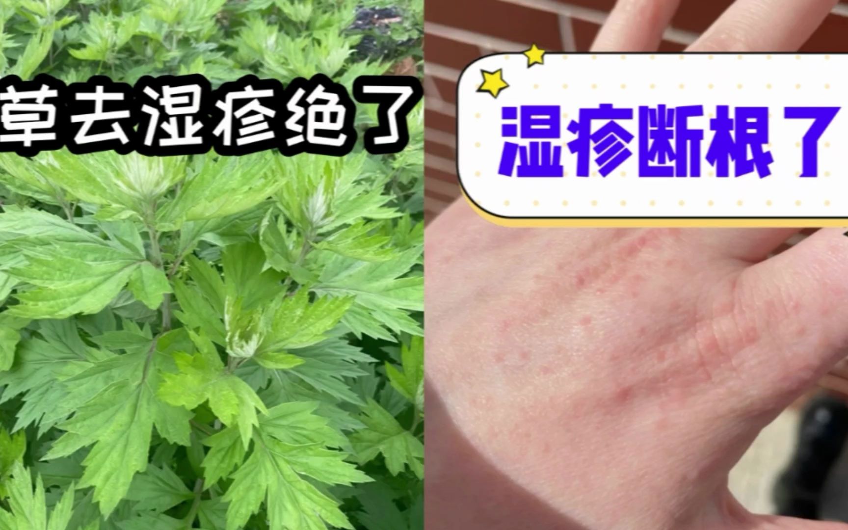 溼疹退退退.艾草去溼疹真的好絕,溼疹瘙癢都斷根了