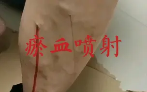 下载视频: 瘀血喷射：学生学习刺血后在家给姐姐操作，疗效很好。