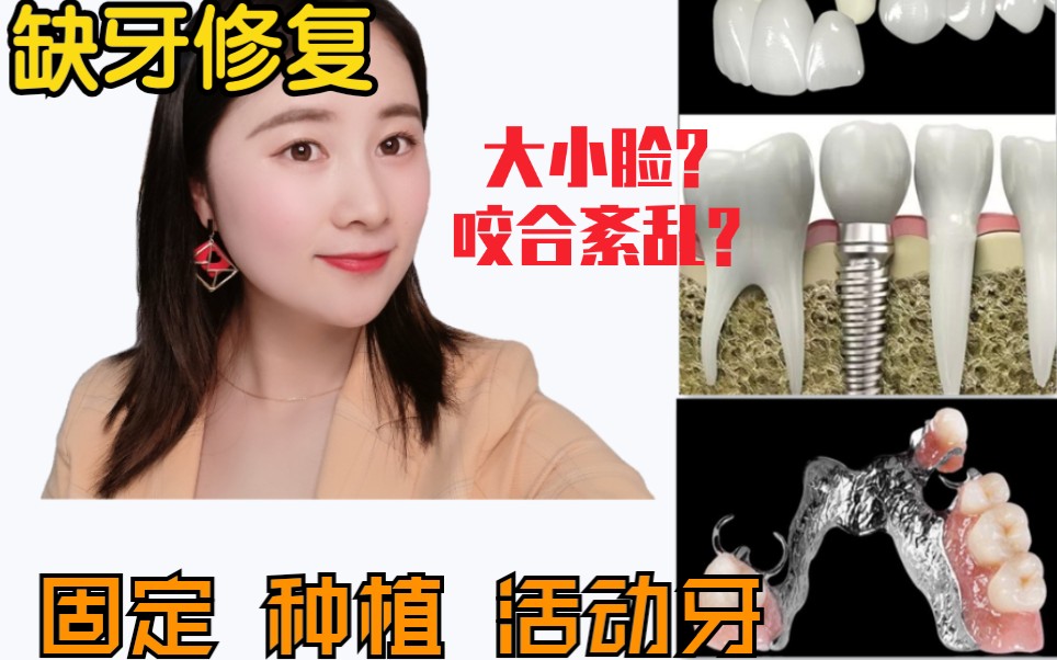 【某医】缺牙有哪几种镶牙方法?惊!不镶牙会大小脸?咬合紊乱?可能再也无法镶牙?哔哩哔哩bilibili