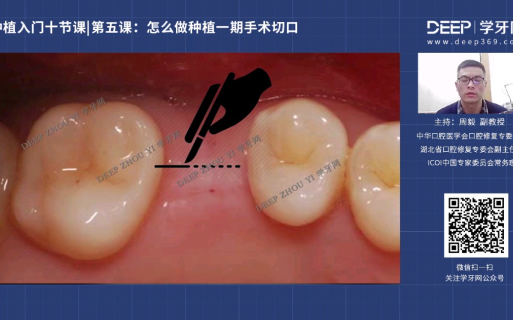 武大周毅 种植入门十节课—怎么做种植一期手术切口哔哩哔哩bilibili