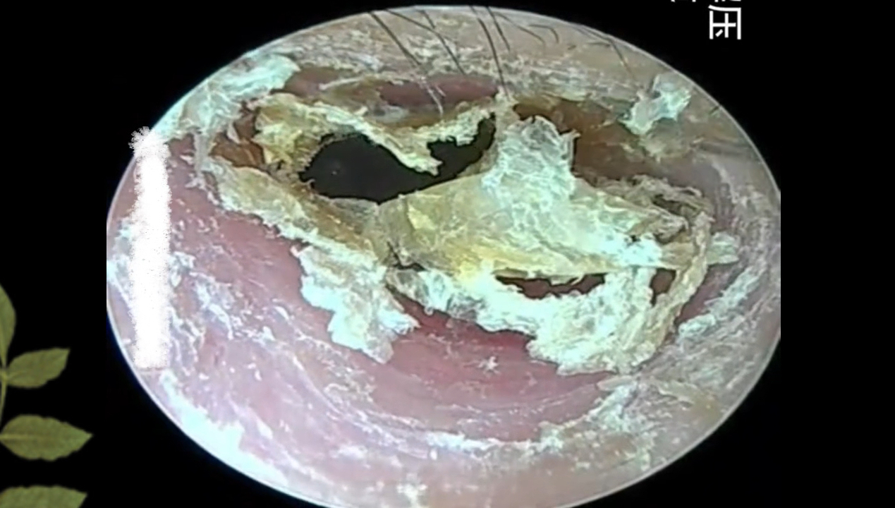 采耳解压;耳朵里好多干巴巴的耳屎哔哩哔哩bilibili