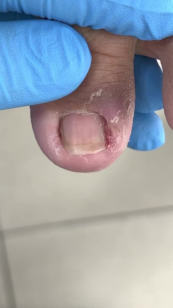 惊人的内嵌甲!脚趾肿痛治疗