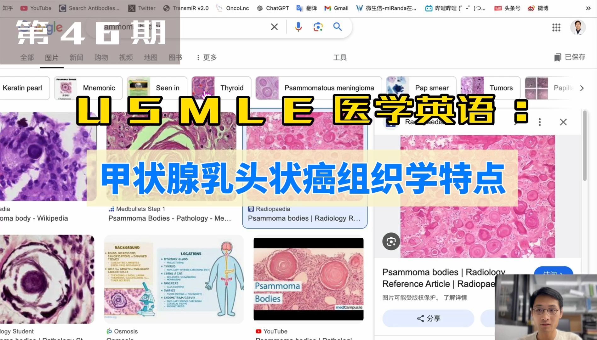 U S M L E 医学英语第46期:甲状腺乳头状癌组织学特点哔哩哔哩bilibili