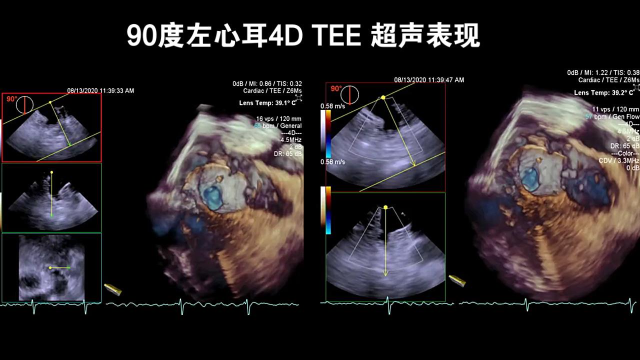 左心耳超声图图片