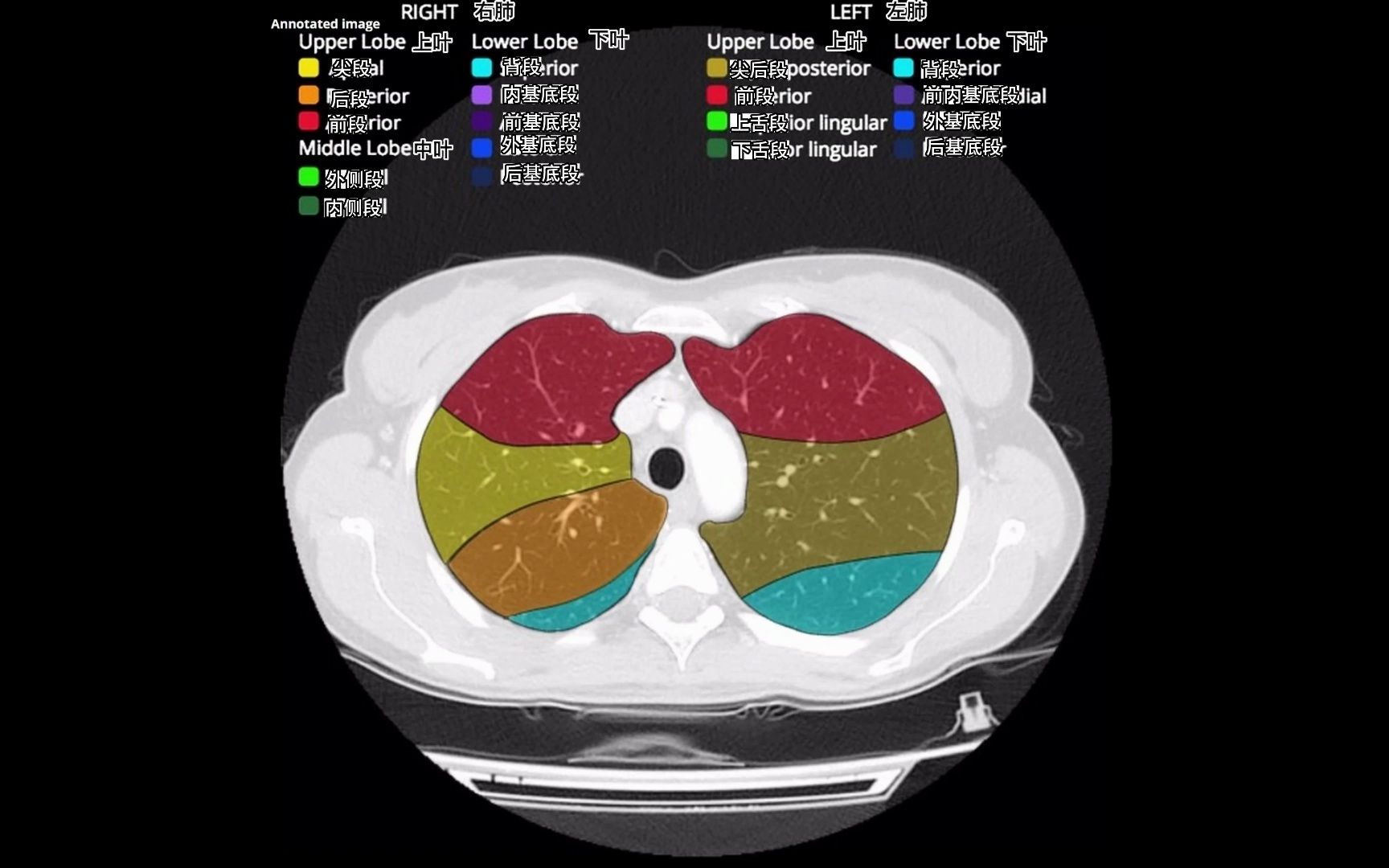 手把手教你学影像!胸部ct的肺部分段,快收藏起来