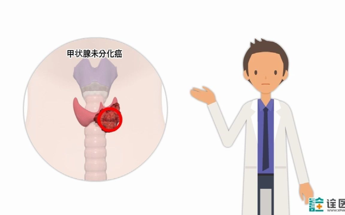 并不是所有的甲状腺癌是“懒惰”的!哔哩哔哩bilibili