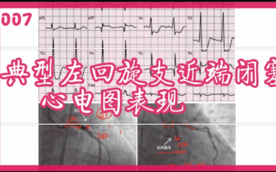 典型左回旋支近端闭塞心电图表现哔哩哔哩bilibili